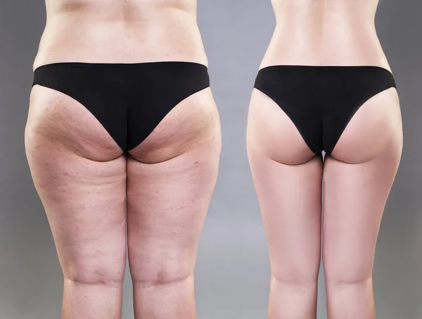 depositphotos_180167824-stock-photo-overweight-woman-with-fat-legs