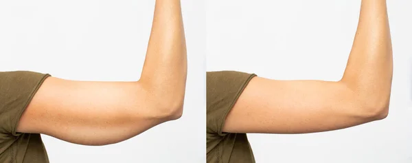 depositphotos_360302610-stock-photo-excess-skin-removal-arm depositphotos_360302610-stock-photo-excess-skin-removal-arm